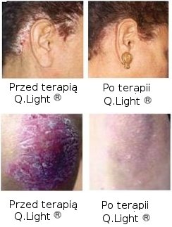 Leczenie uszczycy Q.Light